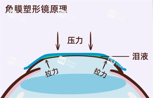角膜塑形镜原理 角膜塑形镜原理