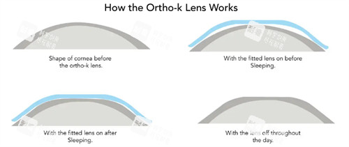 角膜塑形镜改善眼表 角膜塑形镜改善眼表