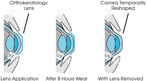 角膜塑形镜矫正眼睛流程图 角膜塑形镜矫正眼睛流程图