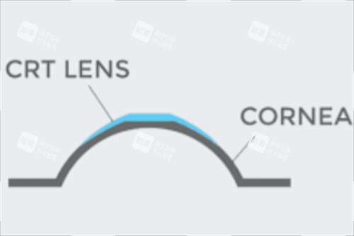 CRT角膜塑形镜示意图 CRT角膜塑形镜示意图
