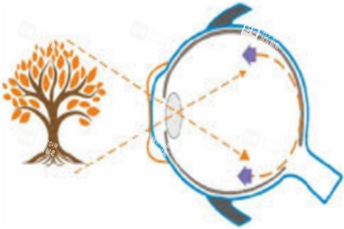 佩戴角膜塑形镜视物