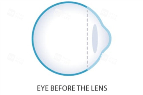 未佩戴角膜塑形镜前