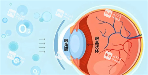 角膜塑形镜佩戴方法