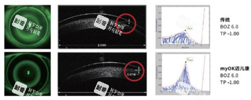 迈儿康角膜塑形镜佩戴前后变化