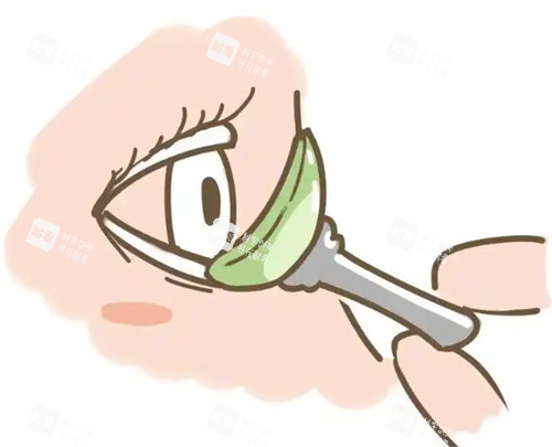 迈儿康ok镜的佩戴过程