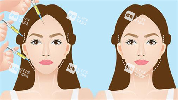 自体脂肪填充面部卡通图