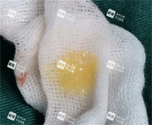 生长因子刚刚注射后取出的样子