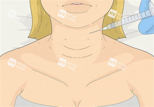 颈纹显老 颈纹显老