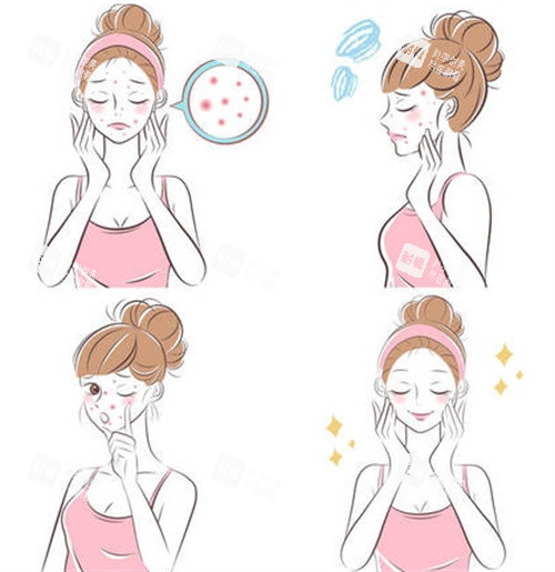 祛痘治疗过程 祛痘治疗过程