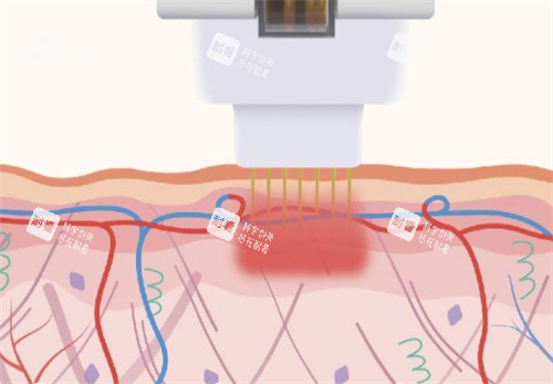 黄金微针施术过程图解 黄金微针施术过程图解