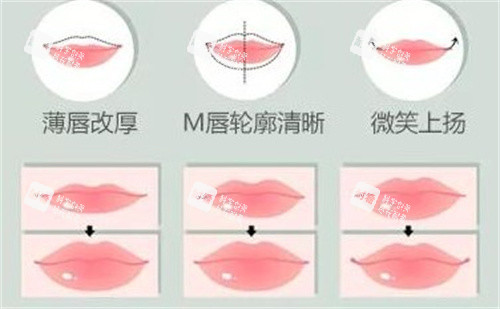 嘴唇整形手术 嘴唇整形手术
