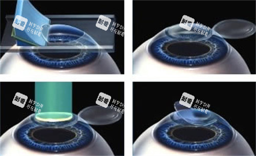 准分子激光手术过程