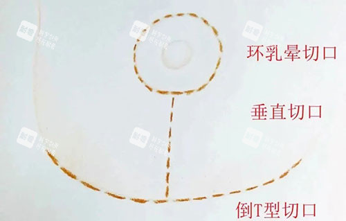 丰胸手术胸部下垂提升倒T字法 丰胸手术胸部下垂提升倒T字法