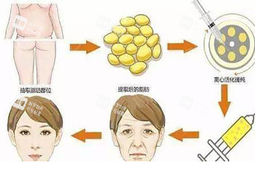 面部脂肪填充过程示意图