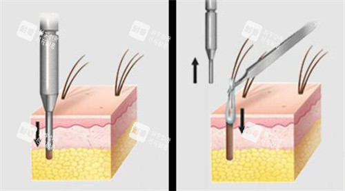 提取毛囊动画演示图图