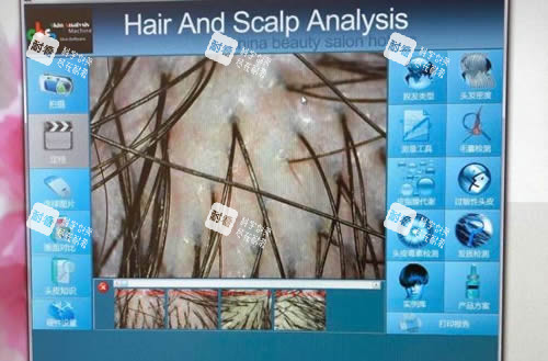 毛囊检测细节图