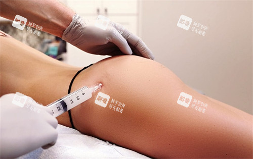 不明注射物丰臀 不明注射物丰臀