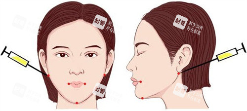 注射点位 注射点位