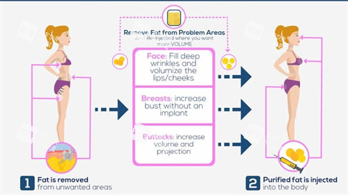 自体脂肪用来丰胸丰臀