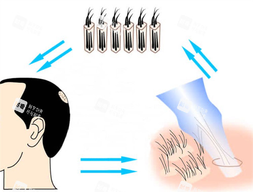 微针吸取毛囊过程图解 微针吸取毛囊过程图解