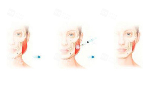 注射瘦脸示意图2 注射瘦脸示意图2