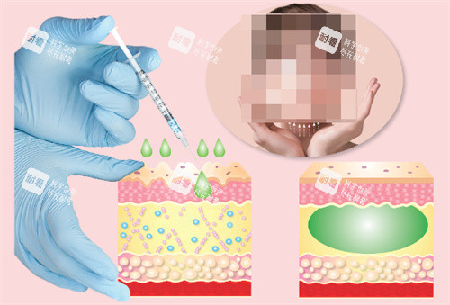 面部注射干细胞 面部注射干细胞