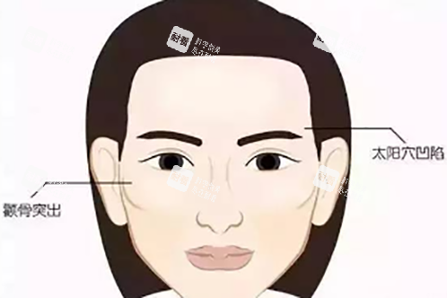 面部轮廓问题示意图 面部轮廓问题示意图