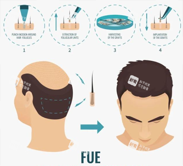 深圳倍生植发FUE植发技术