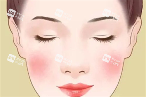 激光去红血丝卡通 激光去红血丝卡通