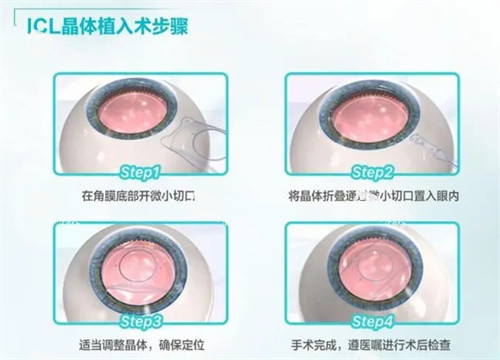ICL晶体植入手术 步骤 ICL晶体植入手术 步骤