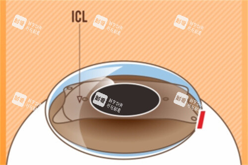 ICL晶体植入后示意图 ICL晶体植入后示意图