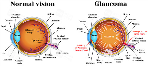 正常眼睛和青光眼的对比图