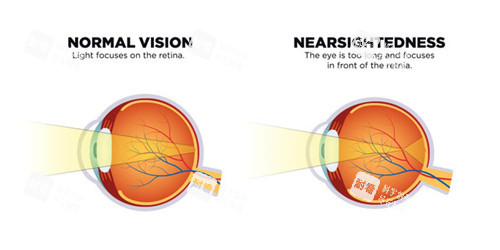 近视眼卡通对比图