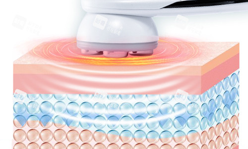 光子嫩肤激光展示 光子嫩肤激光展示