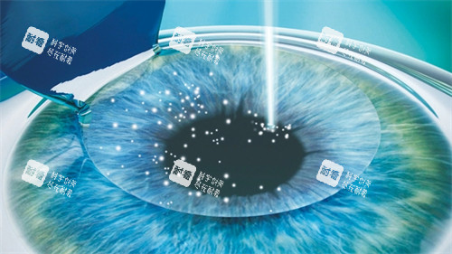 个性化飞秒手术中