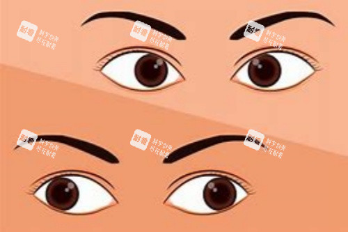 内斜视对比外斜视 内斜视对比外斜视