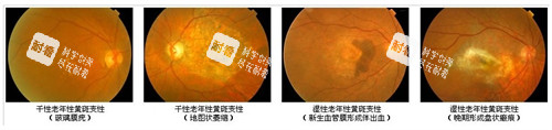 黄斑病变不同的表现