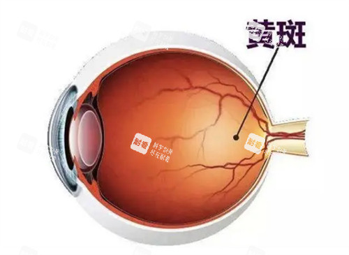 黄斑眼病的样子图解