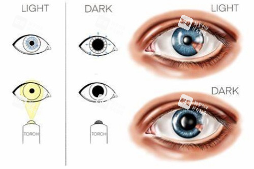 暗瞳对比示意图