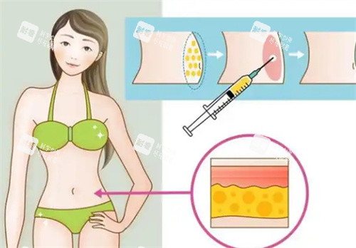 吸脂手术腰部 吸脂手术腰部