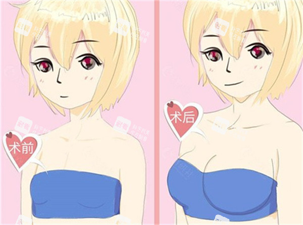 隆胸前后对比图