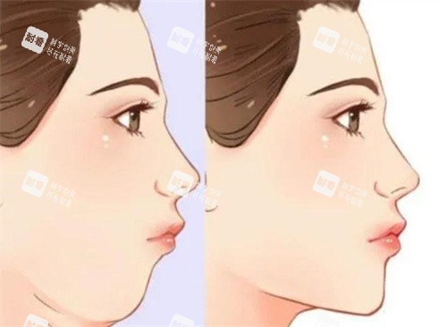 双下巴抽脂前后对比侧面动画图