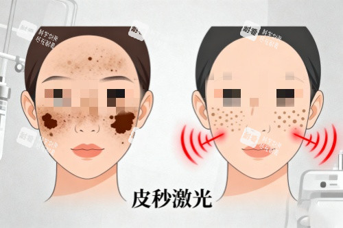脸部做皮秒激光祛斑卡通图