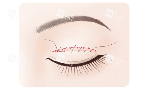 全切双眼皮缝合