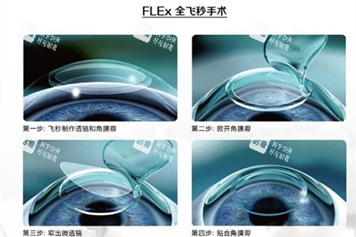 全飞秒手术过程示意图 全飞秒手术过程示意图