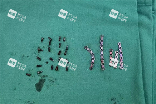 面部轮廓整形固定用钛钉钛板取出展示图 面部轮廓整形固定用钛钉钛板取出展示图