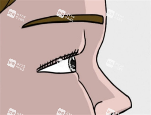 肿眼泡单眼皮示意图 肿眼泡单眼皮示意图