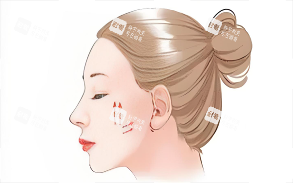 面部提升展示图