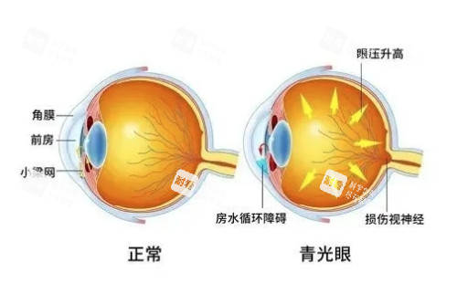 正常眼睛与青光眼概念对比图 正常眼睛与青光眼概念对比图