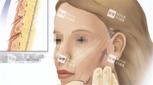 面部青春肽支架提升示意图
